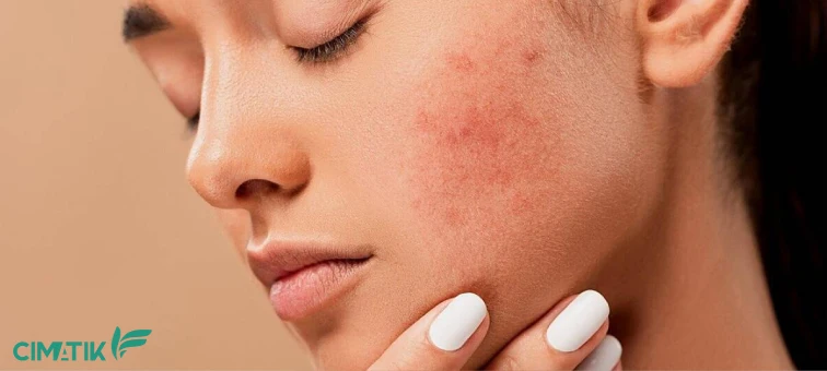 کرم ضدلک گیاهی و طبیعی