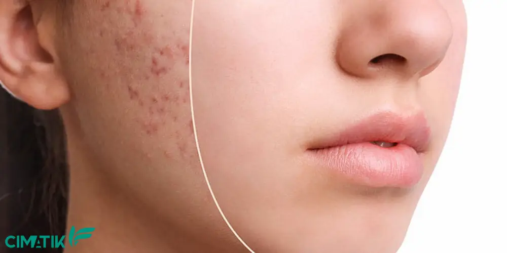 صابون گیاهی برای لک صورت