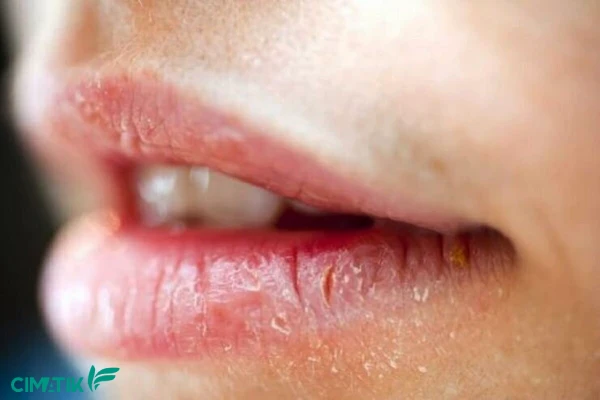 خشکی و ترک لب چیست؟