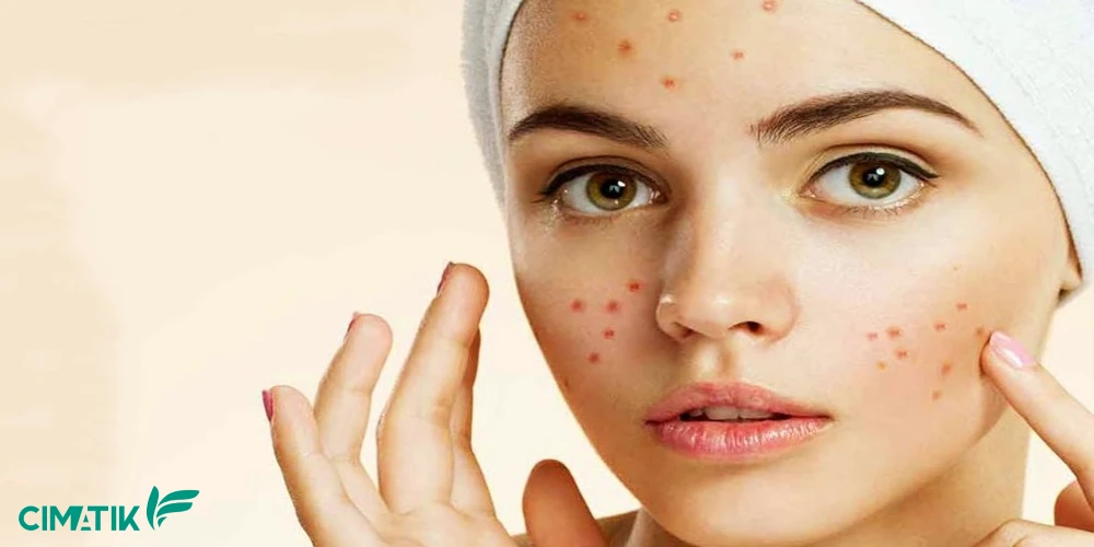 صابون مناسب از بین بردن جای جوش