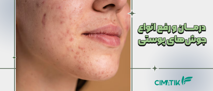 درمان و رفع جوش های پوستی